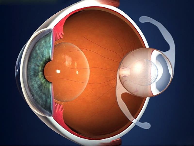 Implants oculaires